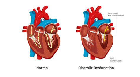 what is the meaning of grade 1 diastolic dysfunction